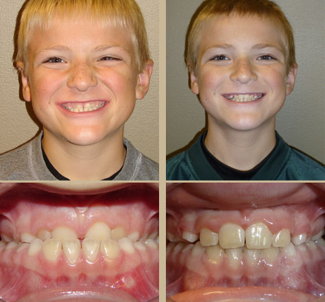 Early treatment, telescoping crossbite