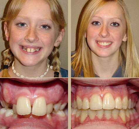 before and after braces adults