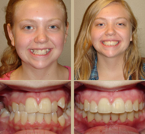 before and after braces adults