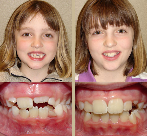Early treatment, crossbite with crowding