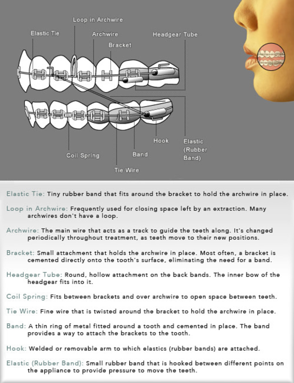 Braces Diagram Orthodontists Near You