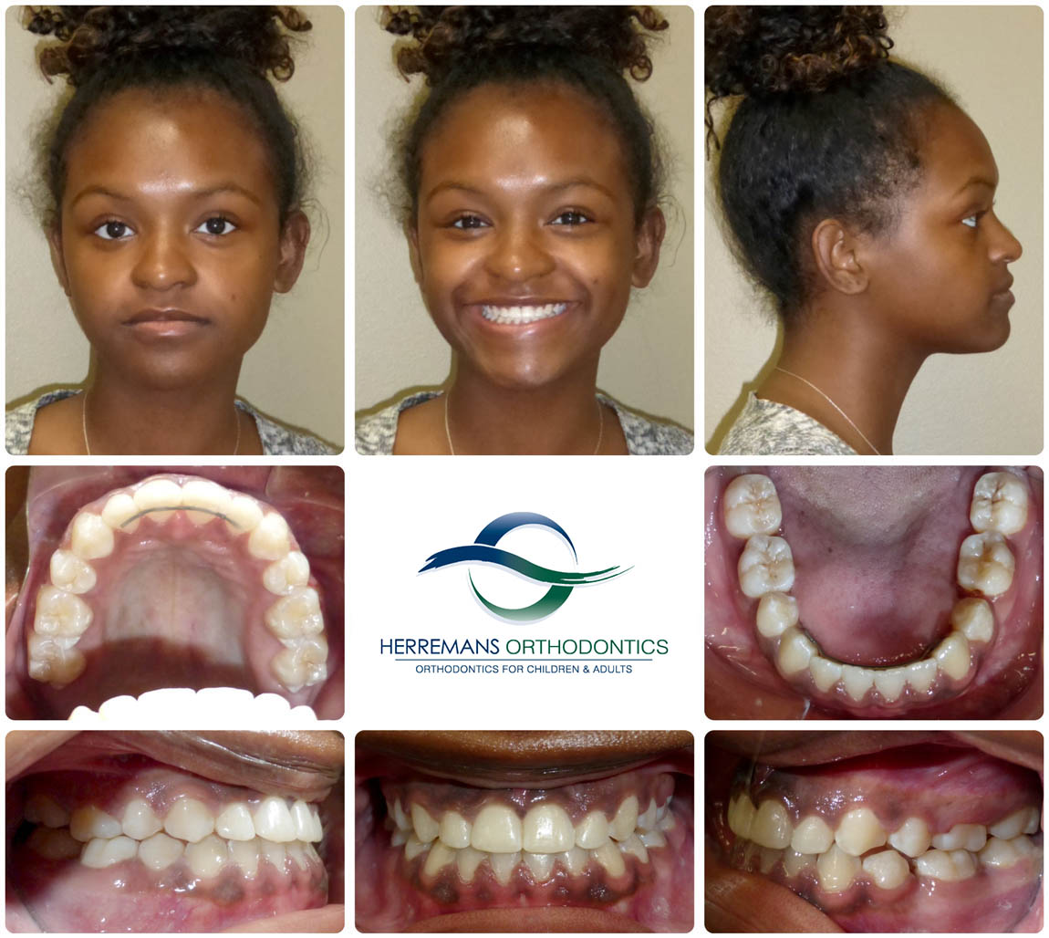 Orthodontist Near Me 1 After Orthodontist Near Me 1 After