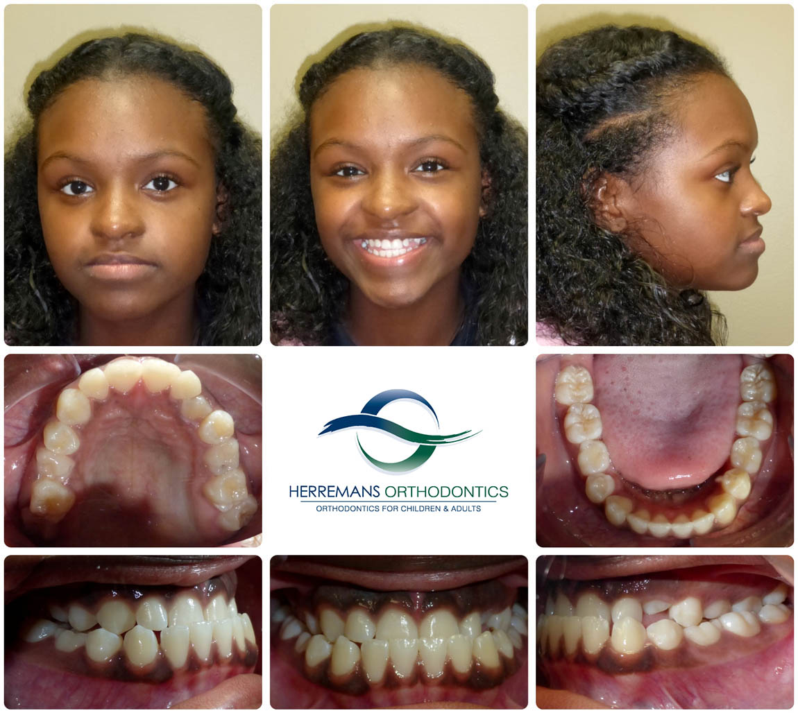 Orthodontist Near Me 1 Before Orthodontist Near Me 1 Before