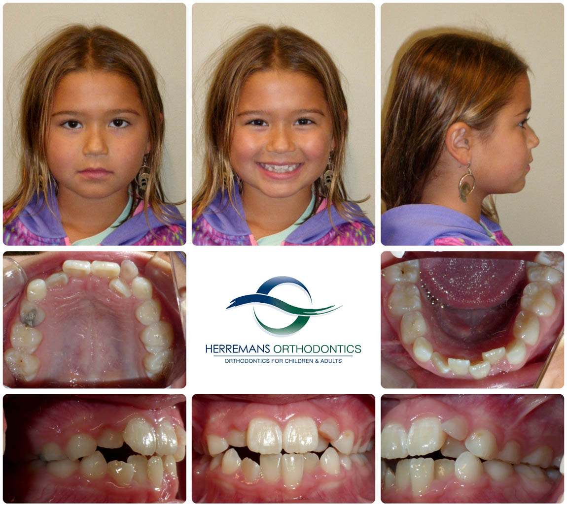 Orthodontist Near Me 10 Before