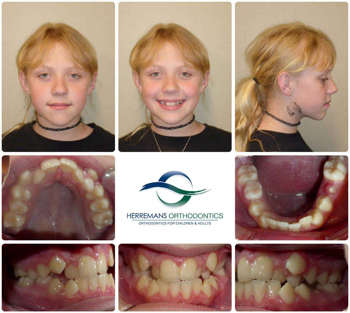 Orthodontist Near Me 11 Before