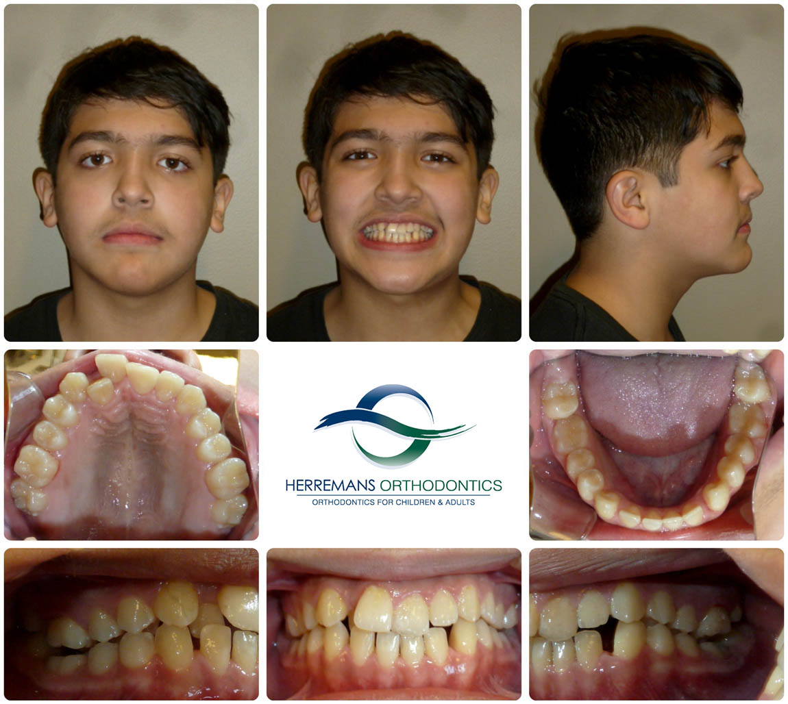 Orthodontist Near Me 13 Before
