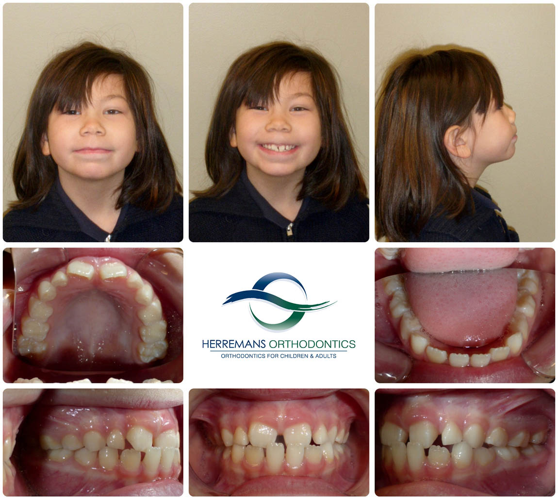 Orthodontist Near Me 17 Before