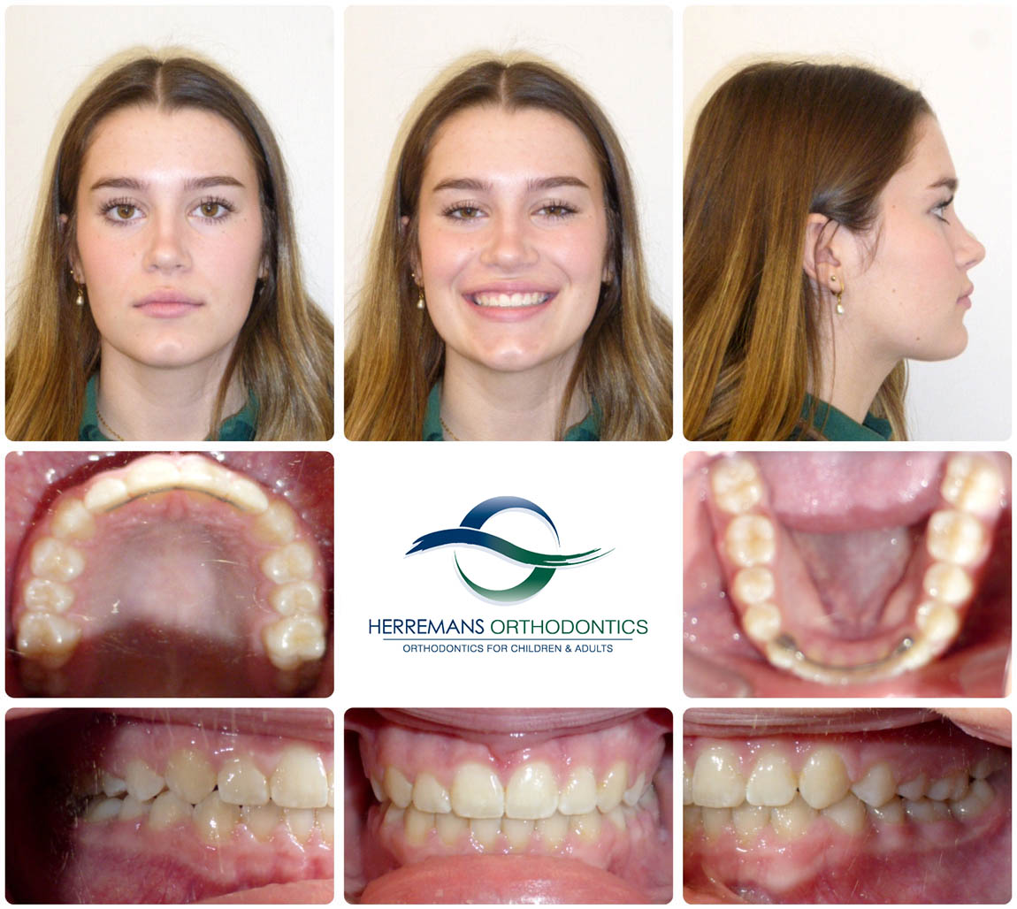 Orthodontist Near Me 2 After Orthodontist Near Me 2 After