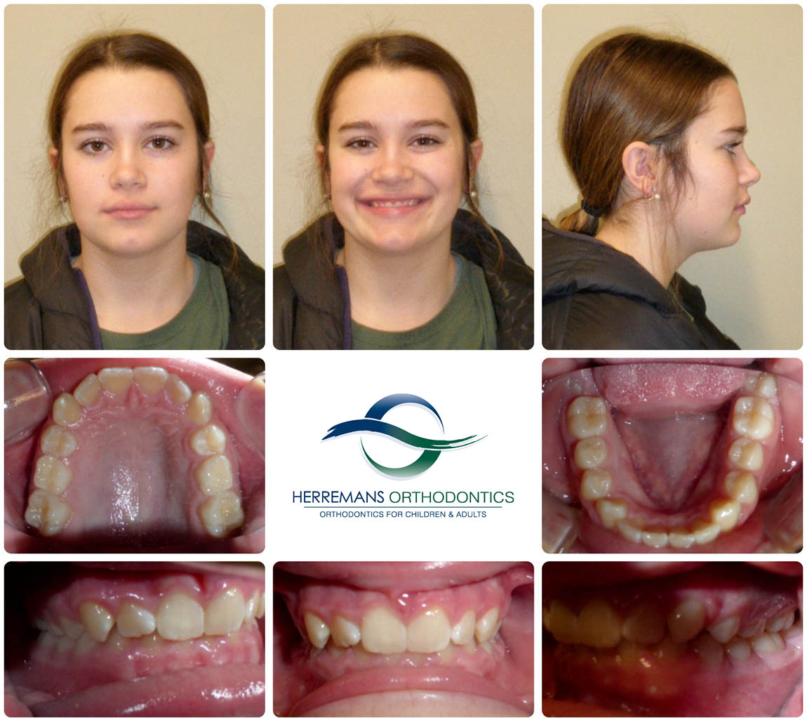 Orthodontist Near Me 2 Before Orthodontist Near Me 2 Before