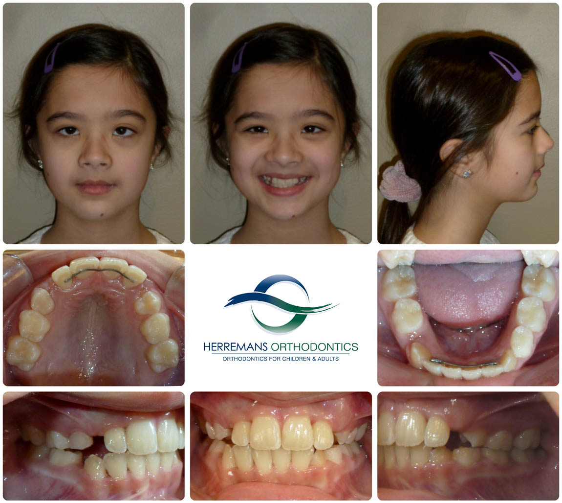 Orthodontist Near Me 3 After Orthodontist Near Me 3 After