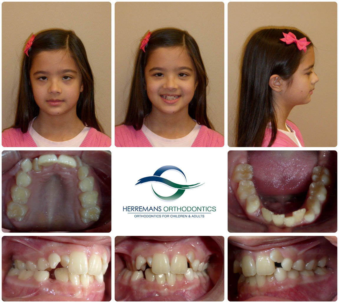 Orthodontist Near Me 3 Before Orthodontist Near Me 3 Before
