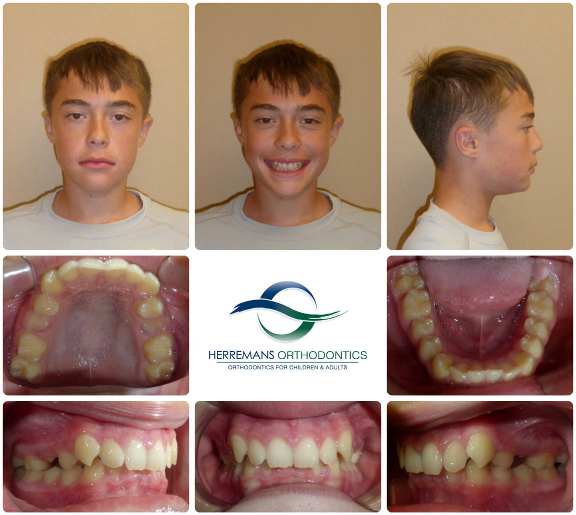 Orthodontist Near Me 4 Before