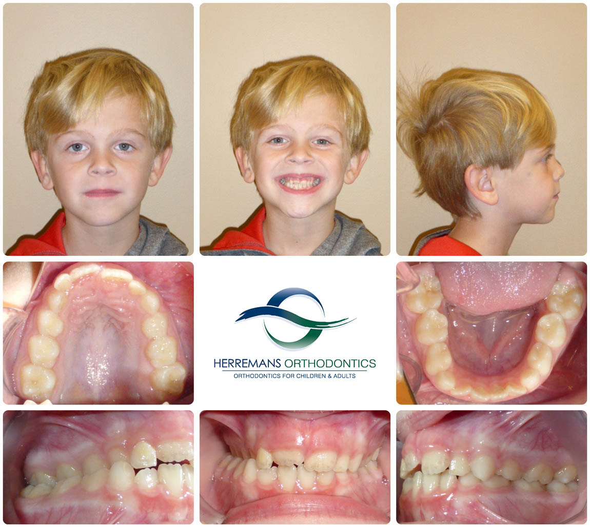 Orthodontist Near Me 5 Before