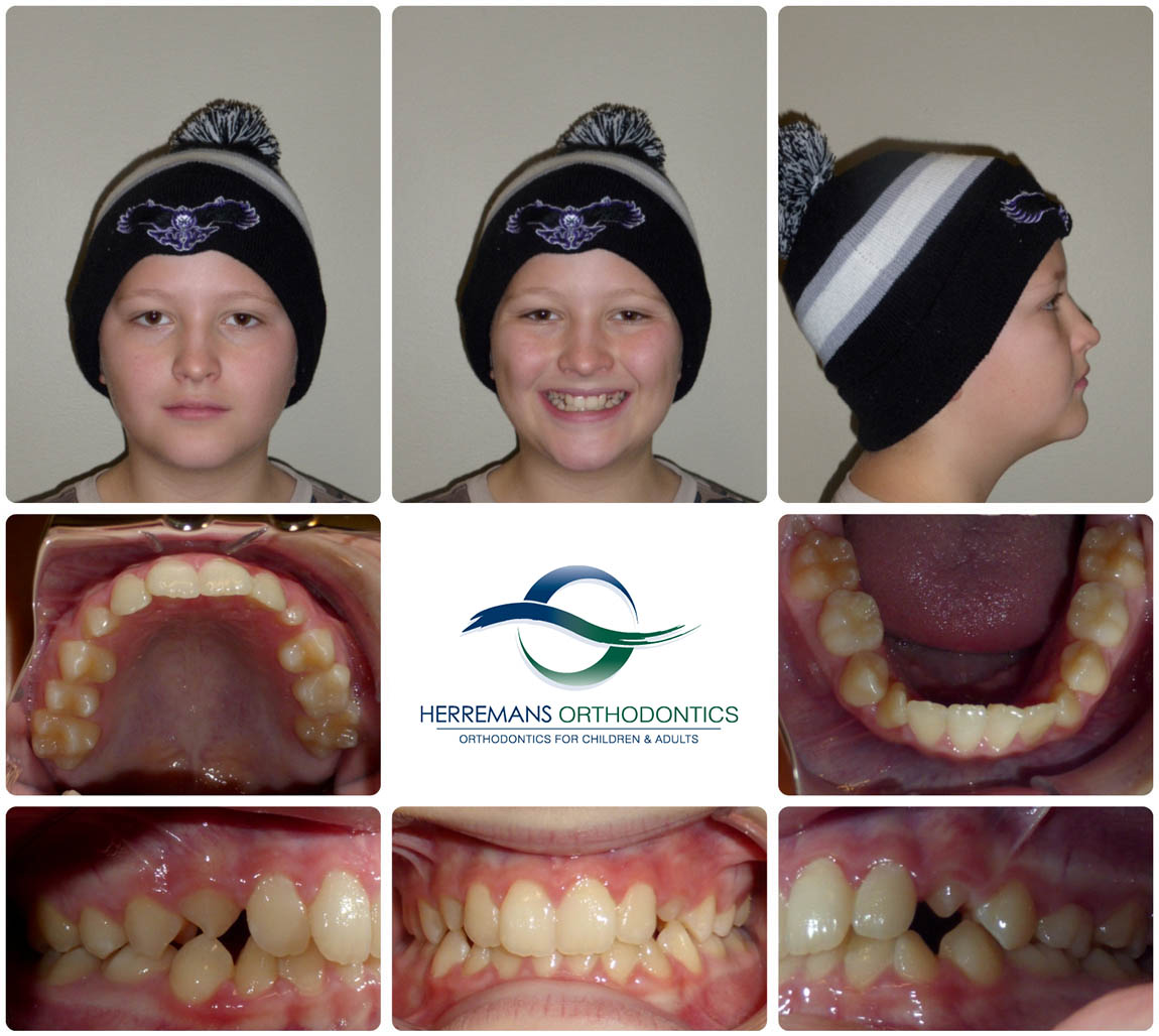 Orthodontist Near Me 6 Before