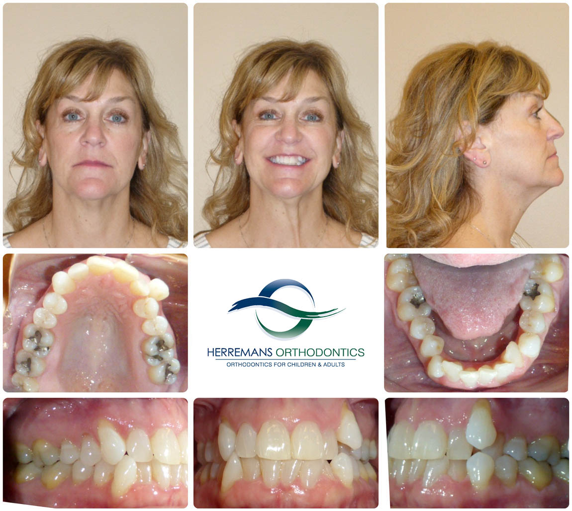 Orthodontist Near Me 7 Before