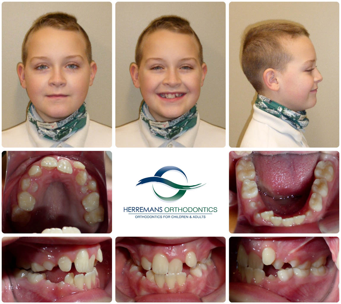 Orthodontist Near Me 8 Before