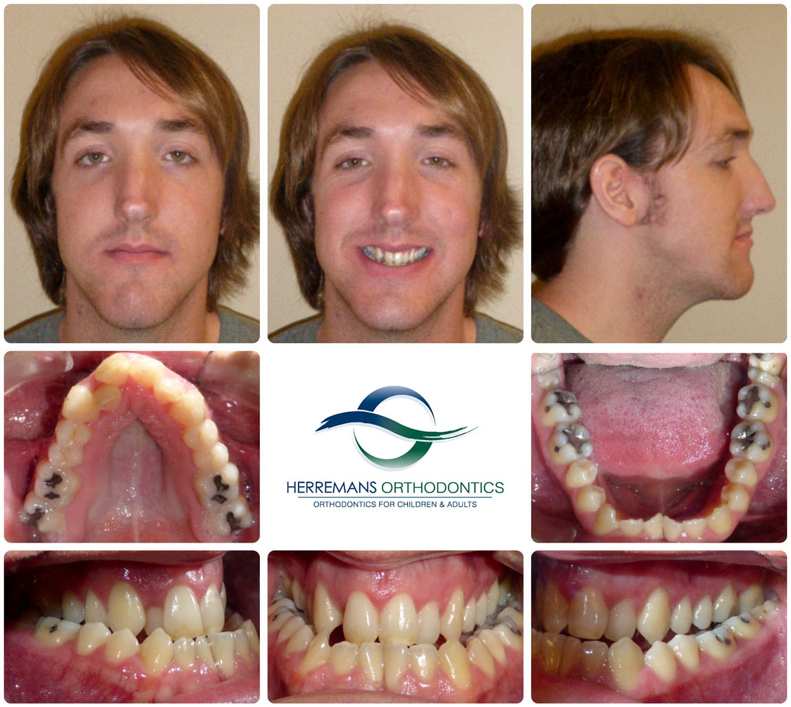 Orthodontist Near Me 9 Before