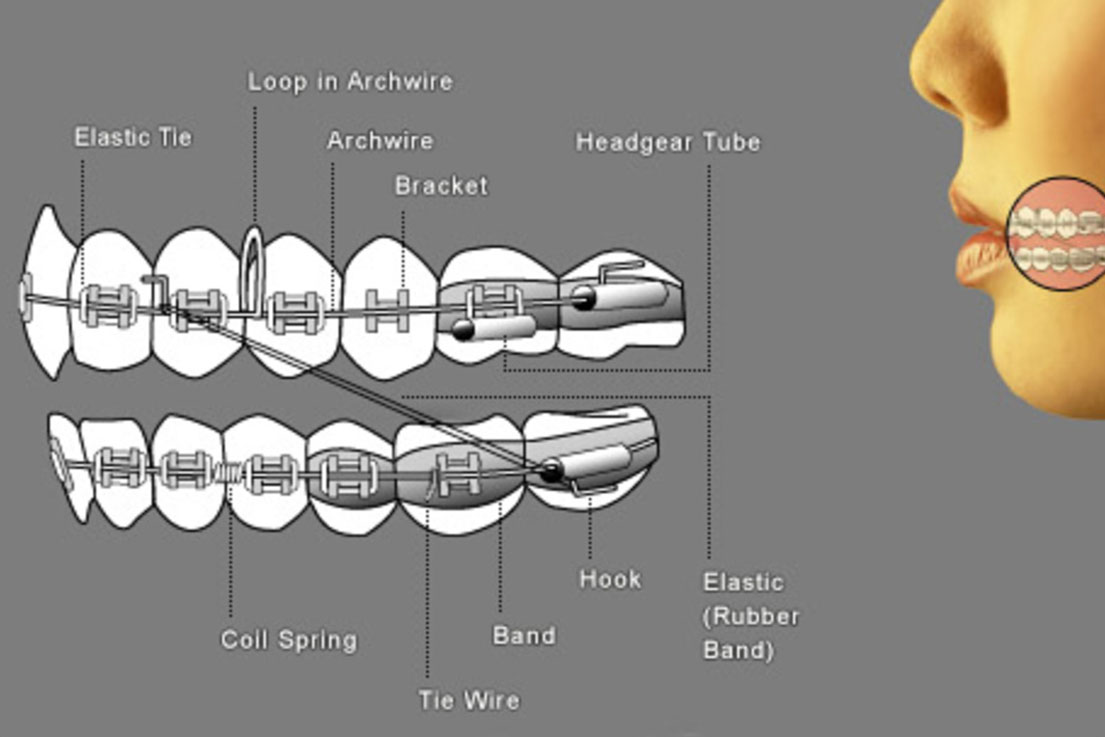 Braces Diagram Orthodontists Near You Braces Diagram Orthodontists Near You